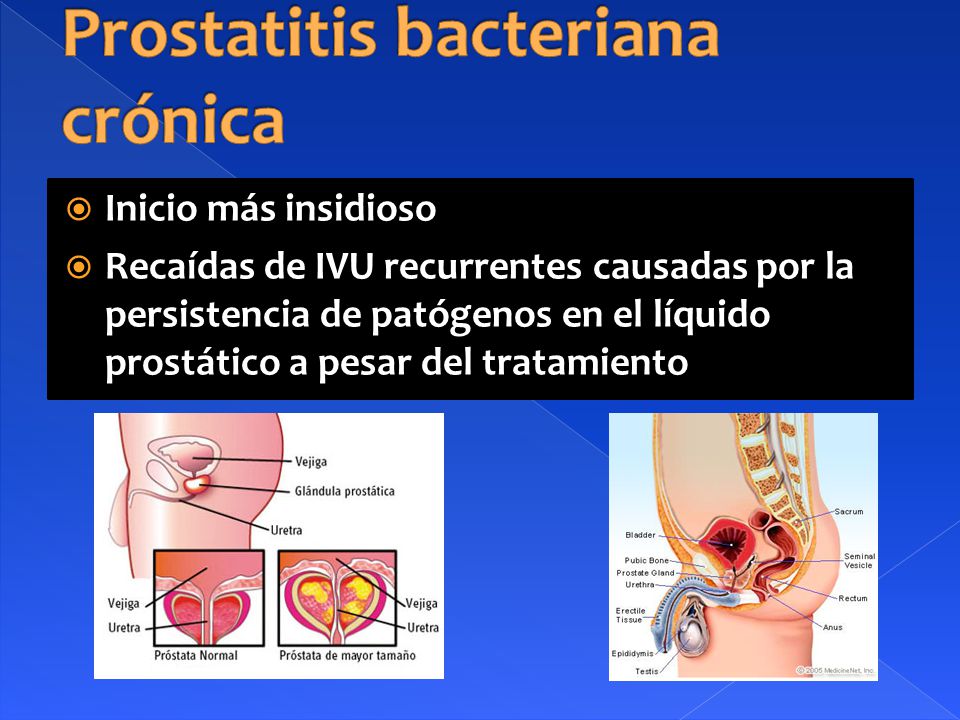prostatitis granulomatosa crónicas